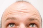 baldness / photo from http://presstv.com