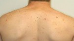 Body Acne – photo from : articlesbase.com